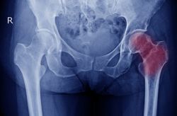 Hoại tử vô mạch (hoại tử xương)