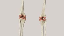 Sarcoma xương là bện gì? Điều trị bằng cách nào?