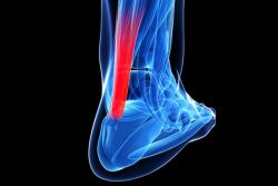 Viêm gân Achilles: Nguyên nhân và cách điều trị