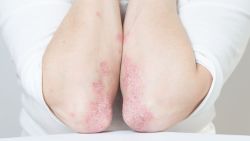 Viêm khớp vảy nến: Triệu chứng và phương pháp điều trị