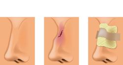 Gãy xương mũi điều trị bằng cách nào?