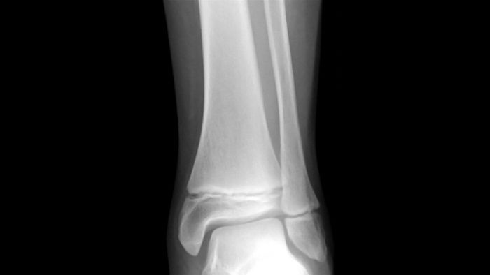 Gãy sụn tăng trưởng: Triệu chứng và cách điều trị