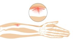 Gãy xương cành tươi là gì?