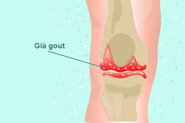 Bệnh giả gout là gì?