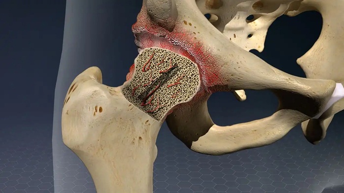 Hoại tử vô khuẩn chỏm xương đùi ở trẻ em