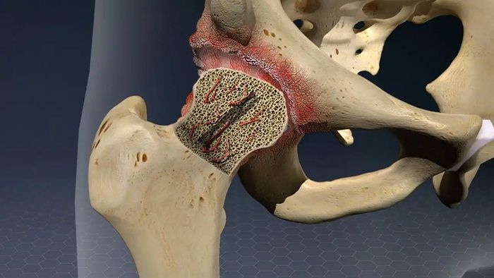 Hoại tử vô khuẩn chỏm xương đùi ở trẻ em