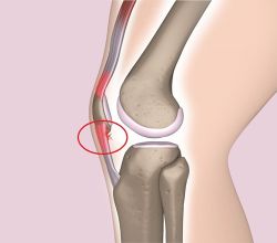 Viêm gân bánh chè