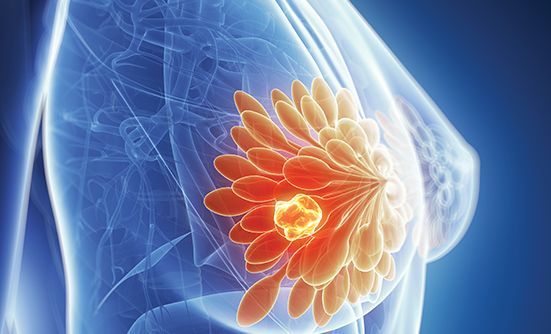 Điều trị ung thư vú giai đoạn 4 như thế nào?