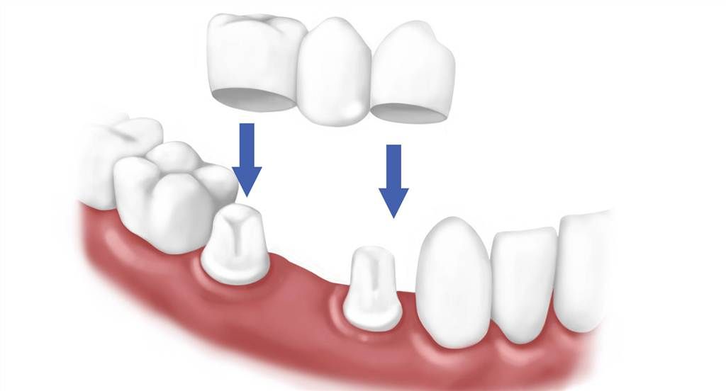 Cách khôi phục răng