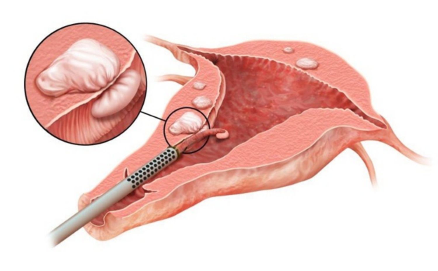 Những điều cần biết về phẫu thuật cắt u xơ tử cung