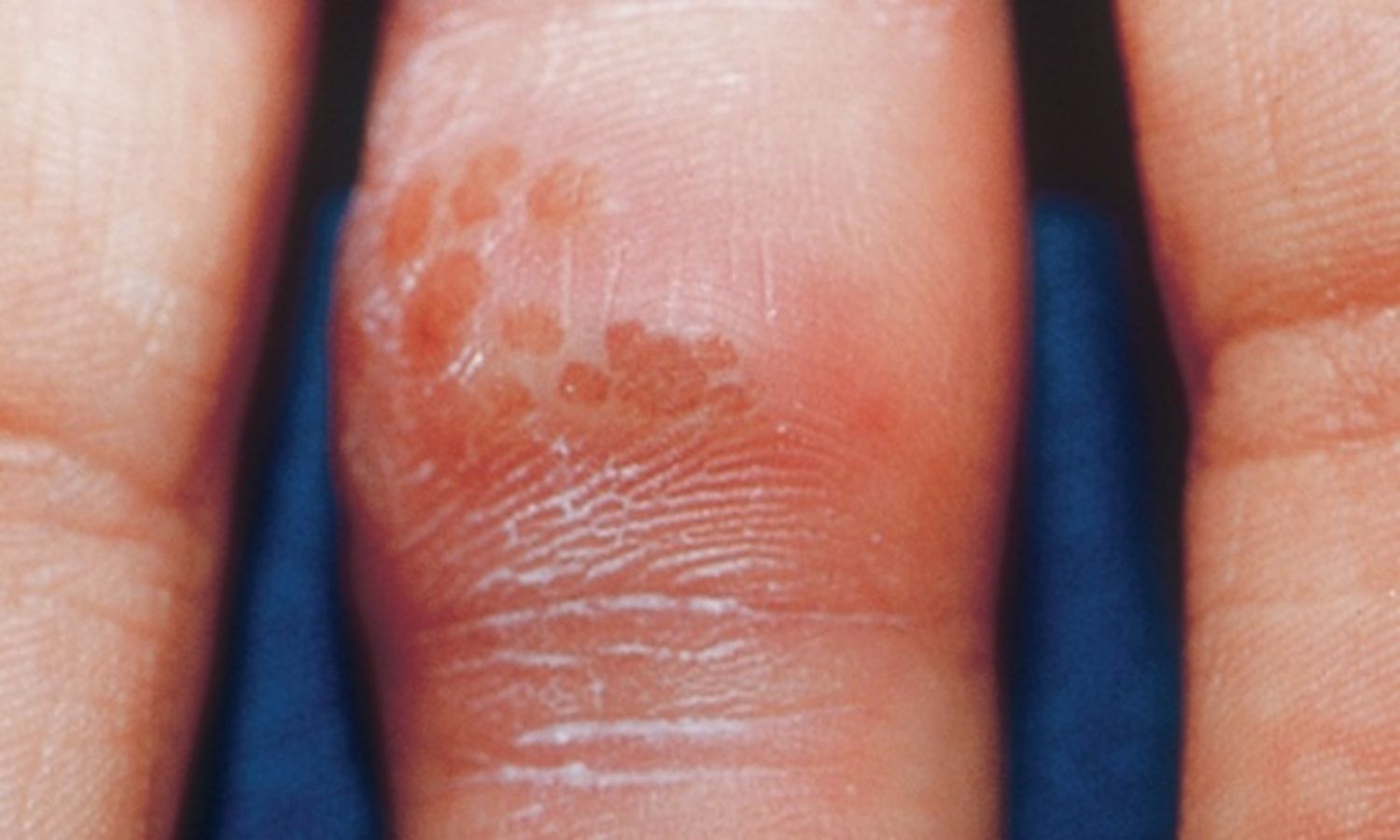 Chín mé do herpes là gì?