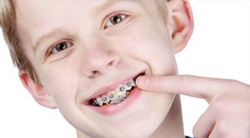 Chỉnh hình răng cho trẻ em