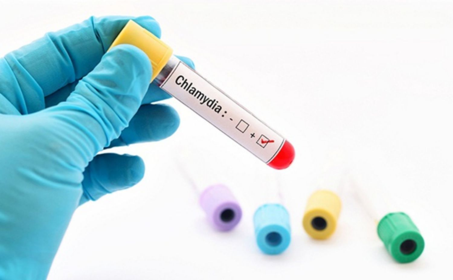 Chlamydia test