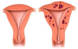 Bệnh cơ tuyến tử cung là gì?