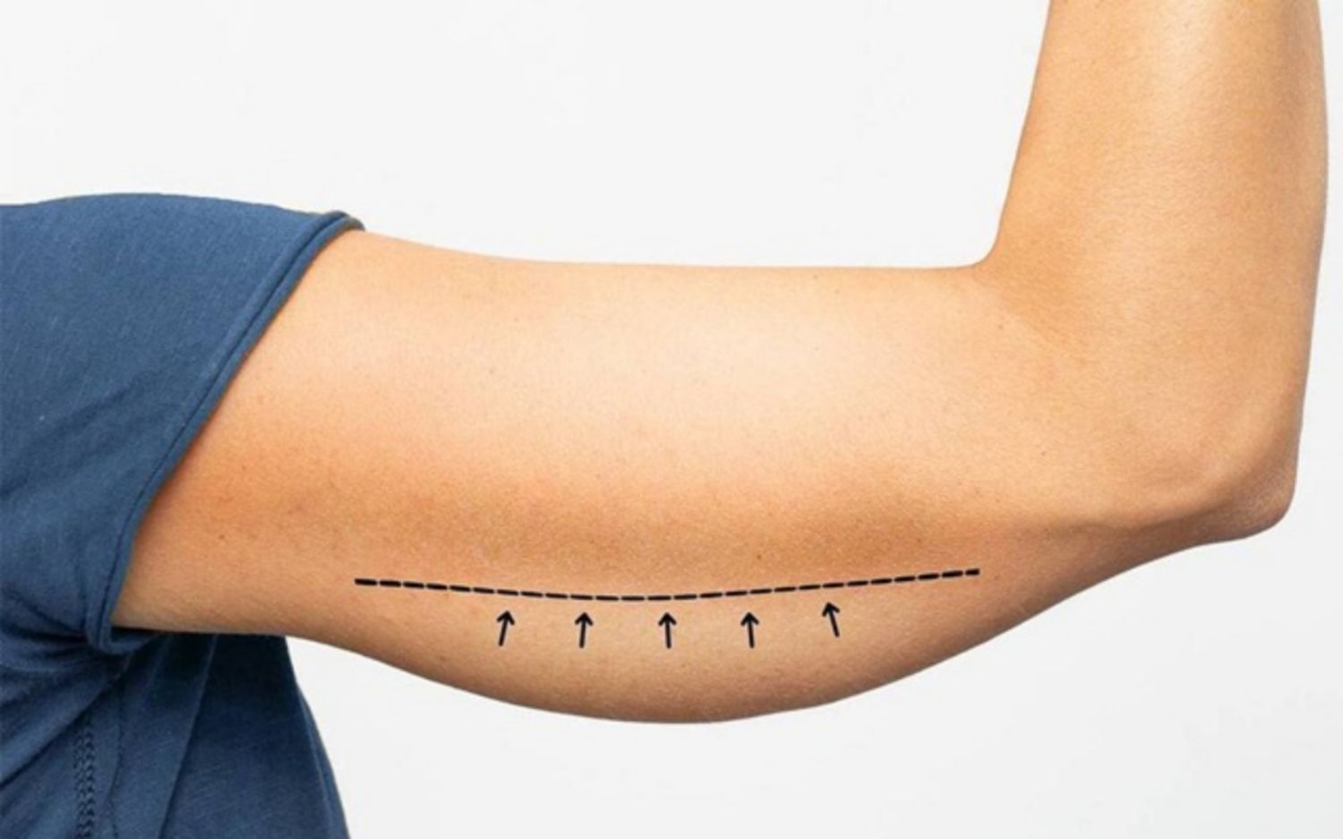 Làm thế nào để khắc phục da chảy xệ sau giảm cân?