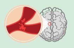 Đột quỵ tắc mạch là gì?