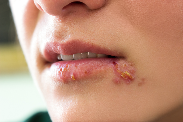 Herpes môi: Nguyên nhân, triệu chứng và cách điều trị