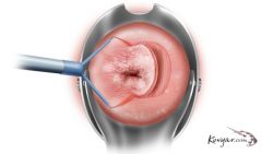 Khoét chóp cổ tử cung bằng vòng điện là gì?