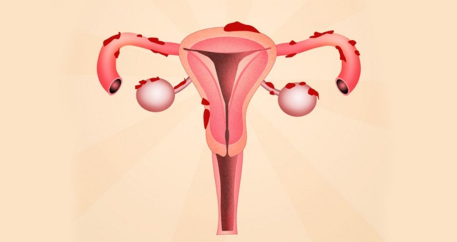 Lạc nội mạc tử cung và cơ tuyến tử cung có gì khác nhau?