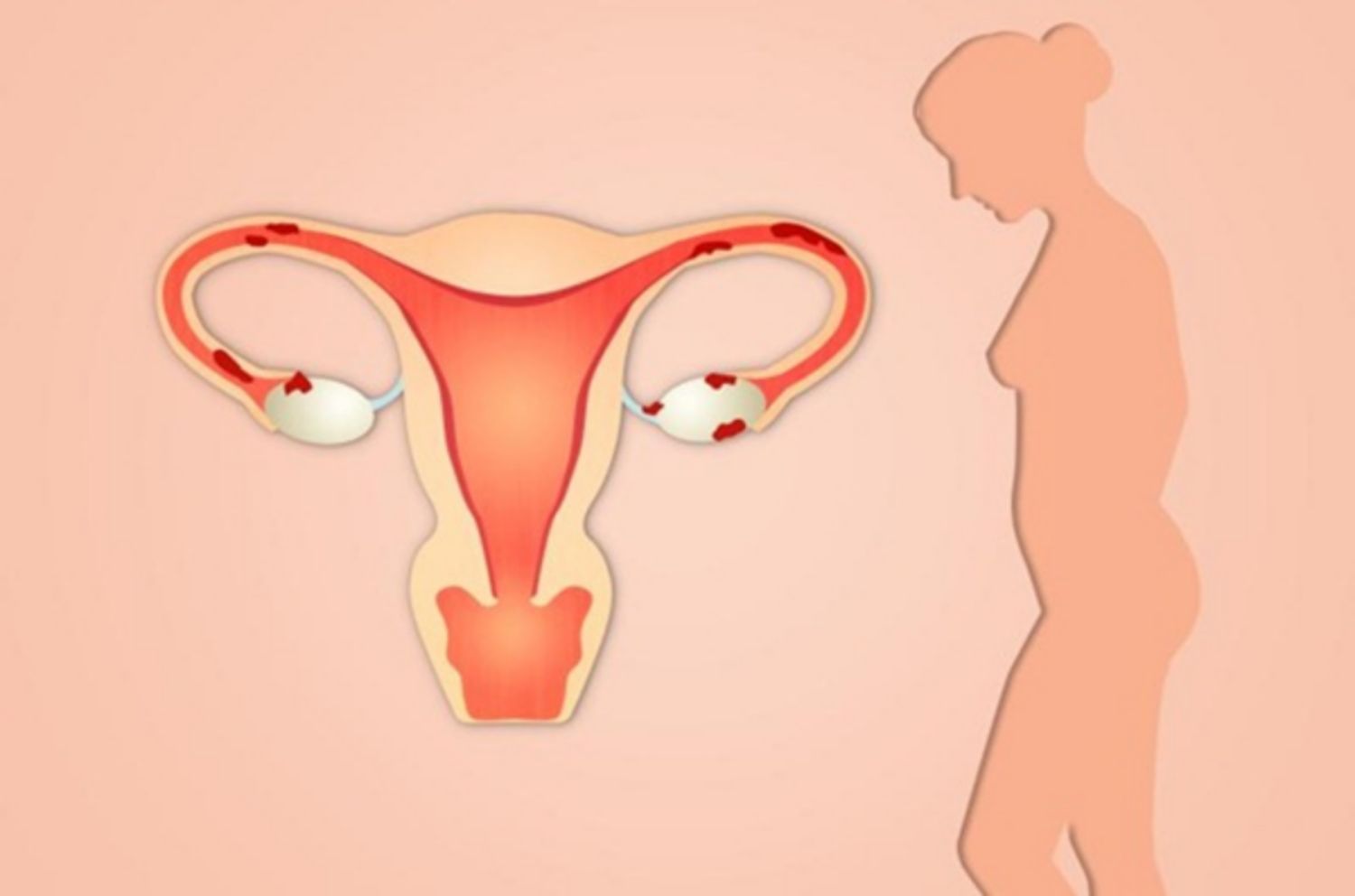 Lạc nội mạc tử cung có gây tử vong không?