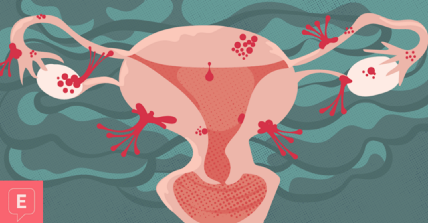 Lạc nội mạc tử cung có trở thành ung thư không?