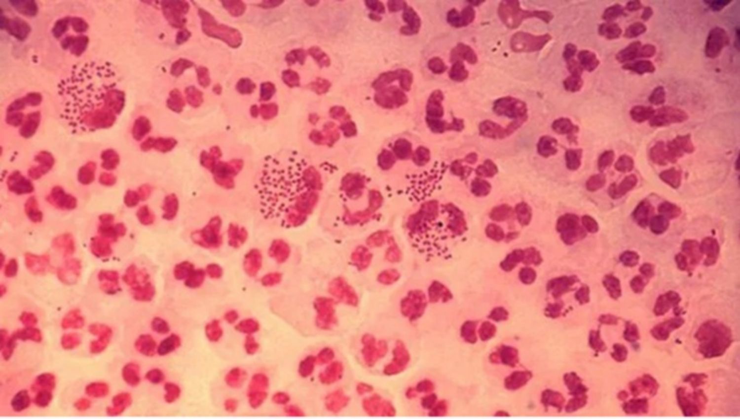 Nhiễm lậu cầu lan tỏa là gì?