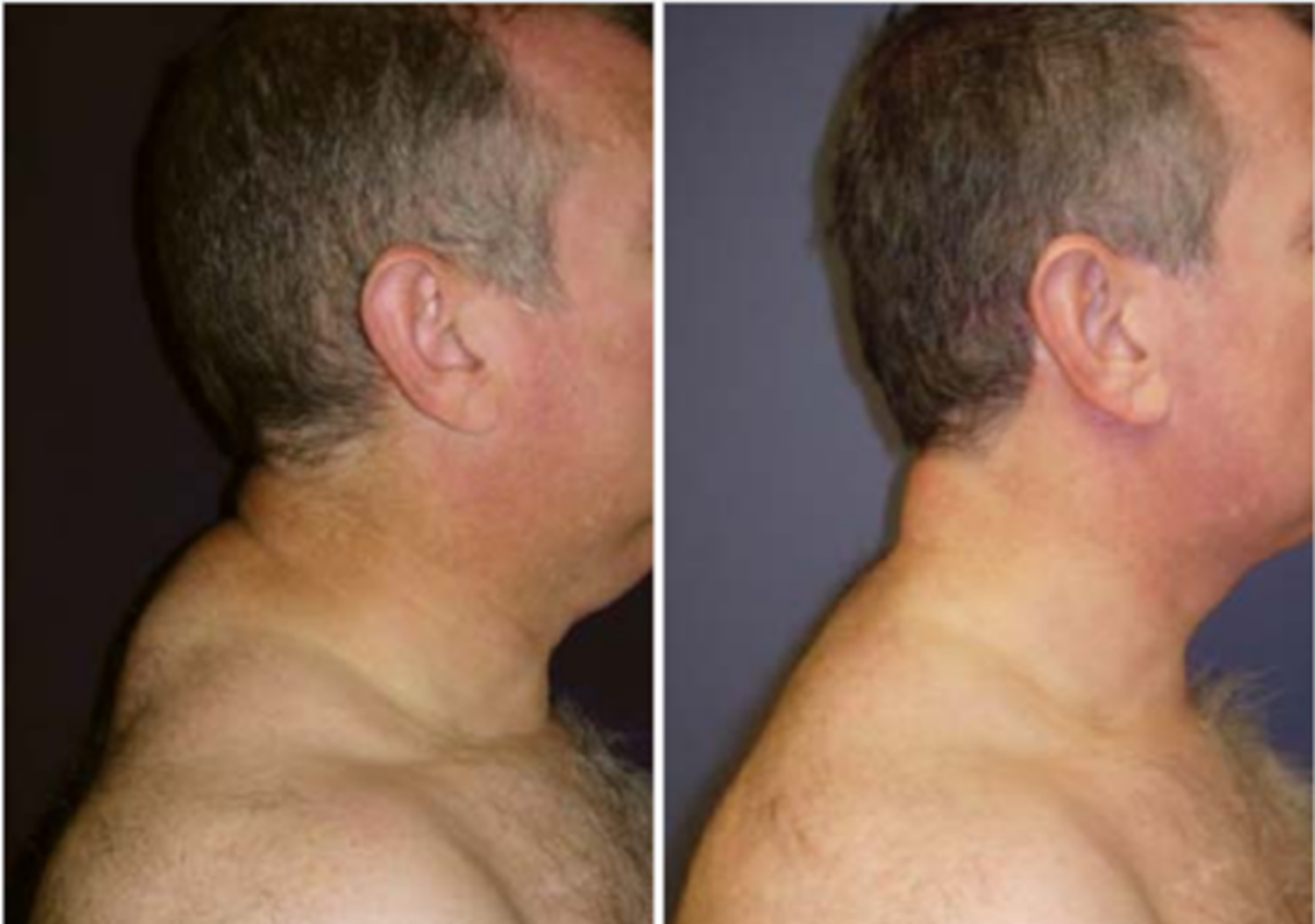 Cách khắc phục loạn dưỡng mỡ do HIV