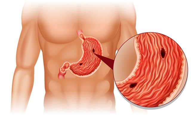 Loét dạ dày: Triệu chứng và cách điều trị