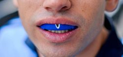 Máng bảo vệ miệng