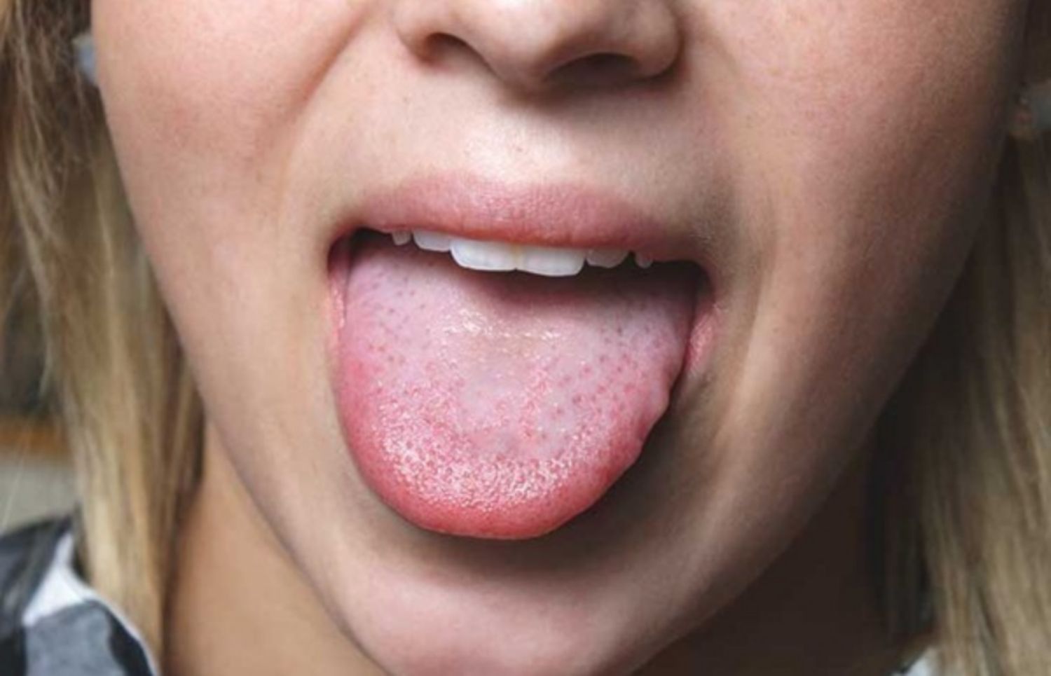 Trị mụn cóc trên lưỡi bằng cách nào?