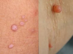 Phân Biệt Mụn Thịt Và Mụn Cóc Sinh Dục Như Thế Nào?