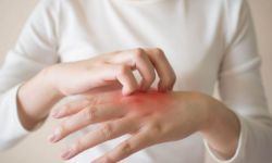 Mụn cóc có ngứa không?