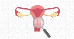 Nguyên nhân gây ung thư cổ tử cung