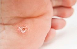 Điều trị và ngăn ngừa mụn cóc Plantar