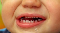 Răng Hutchinson – dấu hiệu của bệnh giang mai bẩm sinh