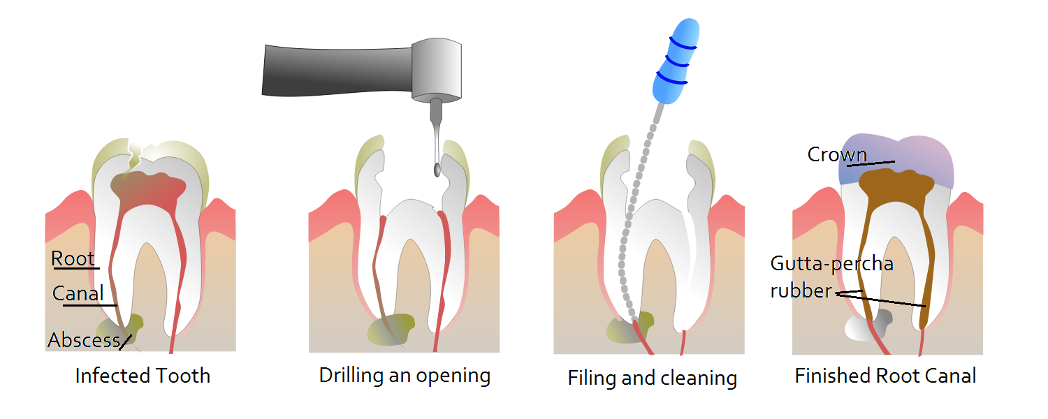 Rút tủy răng (root canal)