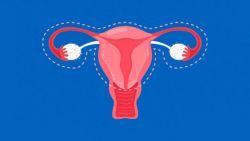 Cắt tử cung sẽ để lại sẹo ở đâu?