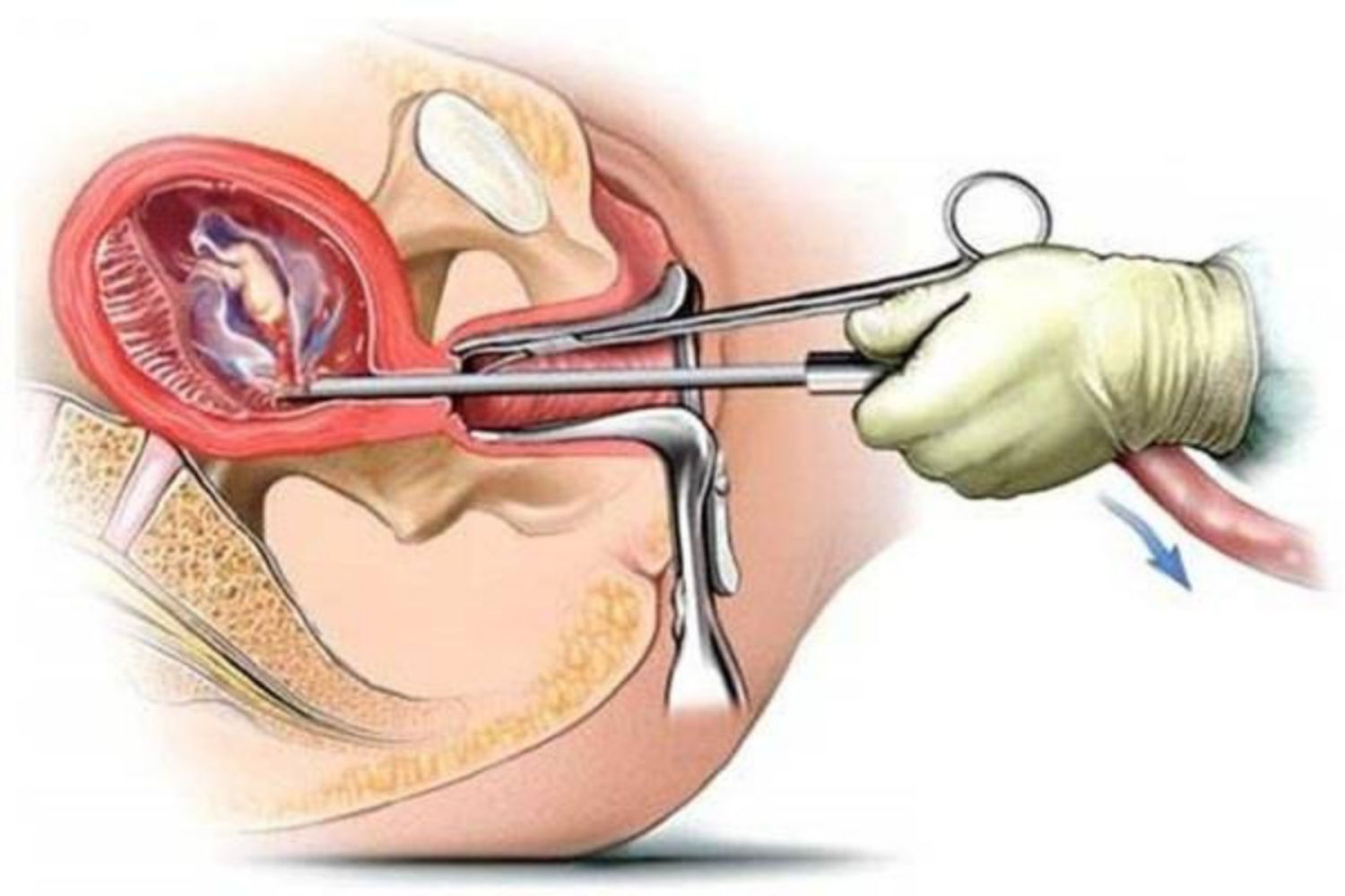 Sinh thiết nội mạc tử cung để làm gì?