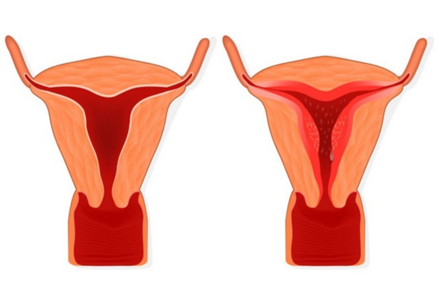 Tử cung bình thường (bên trái) và tăng sản nội mạc tử cung (bên phải)