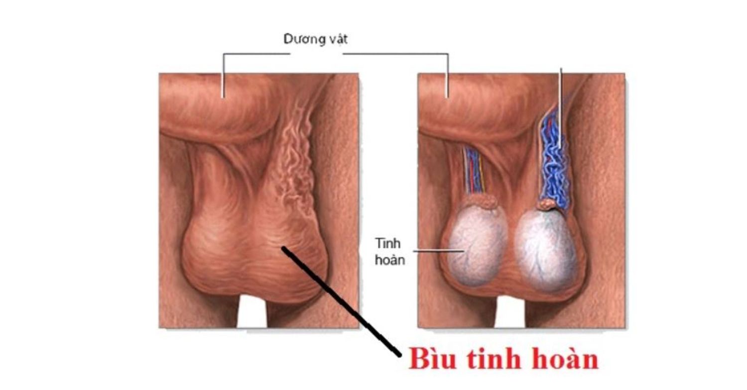 Tạo hình bìu - Nam khoa Penuma