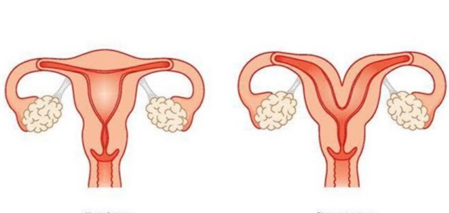 Tử cung hai sừng là gì và ảnh hưởng như thế nào đến khả năng sinh sản?