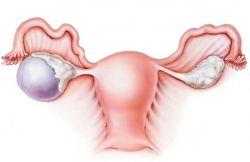 U nang buồng trứng thực thể là gì?