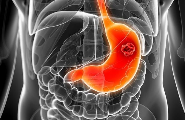 Ung Thư Dạ Dày Giai Đoạn 4 Sống Được Bao Lâu?