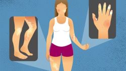 Xơ cứng bì toàn thể: Nguyên nhân, triệu chứng và cách điều trị