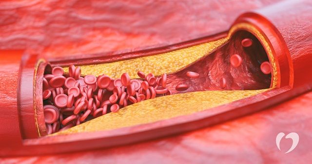 Có thể khắc phục hậu quả do xơ vữa động mạch không?