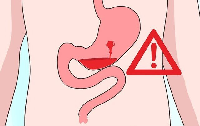 Xuất huyết tiêu hóa có nguy hiểm không?