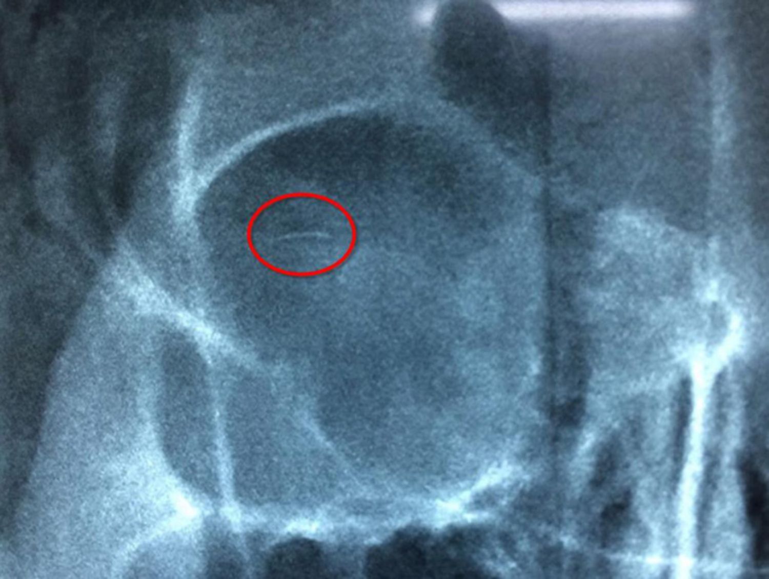 Kết quả chụp phim X-quang cho thấy có vật thể lạ giống như chiếc kim ở trong mắt của bệnh nhân