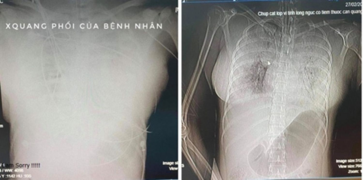 Hình ảnh chụp X-quang phổi và CT lồng ngực cho thấy phổi đông đặc, xuất huyết nhiều