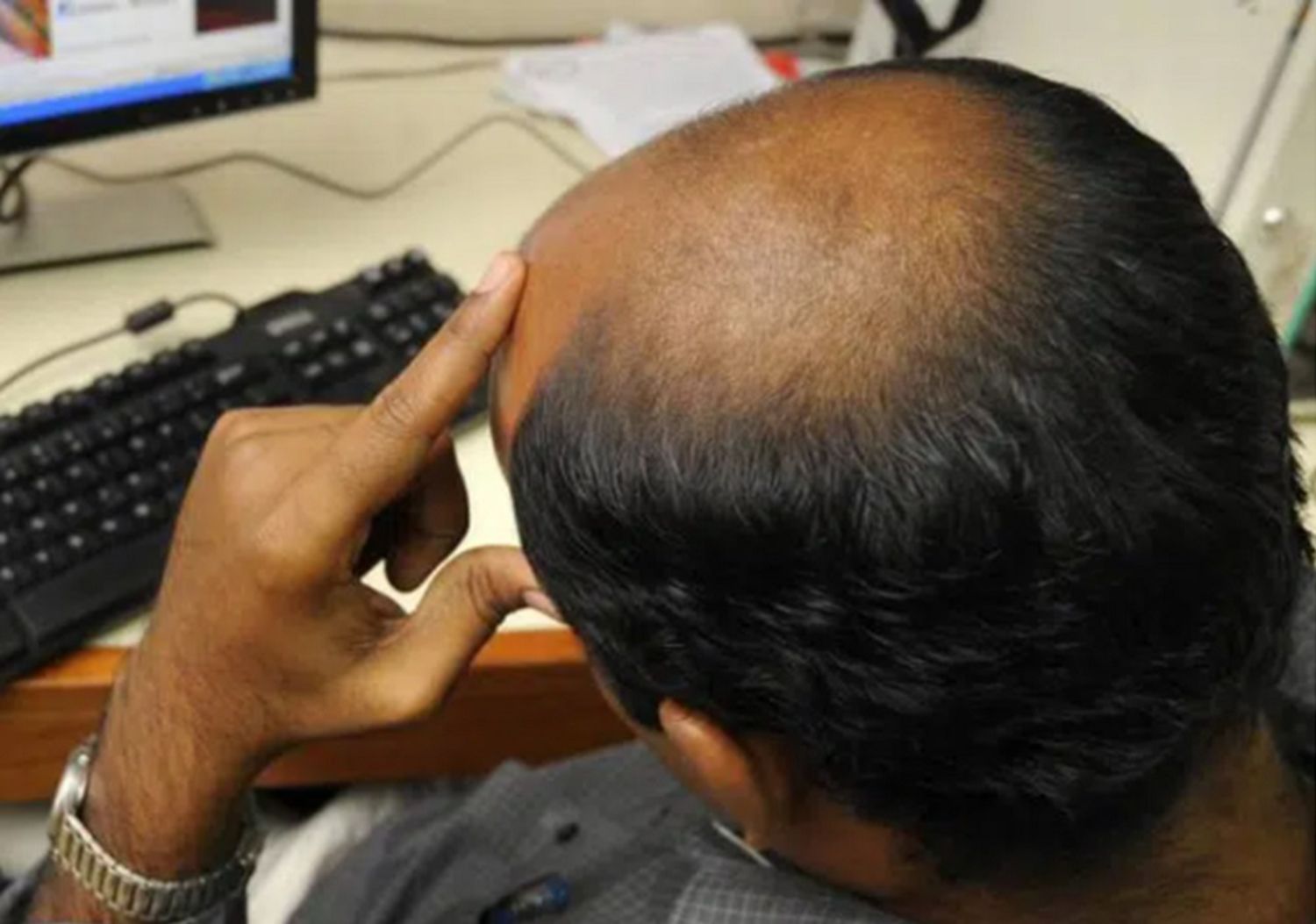 Không ngờ đầu hói lại là điểm trừ cực lớn của đàn ông trong mắt phụ nữ Ấn Độ (Ảnh minh họa)