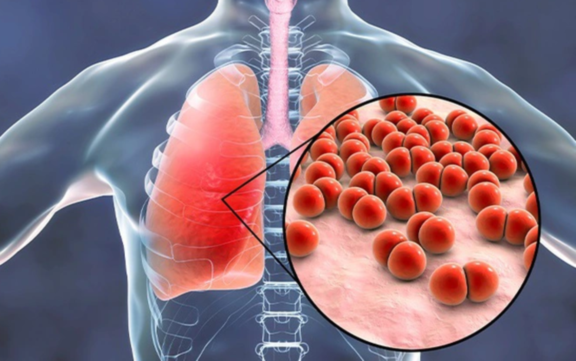 Cách phòng ngừa viêm phổi do Mycoplasma